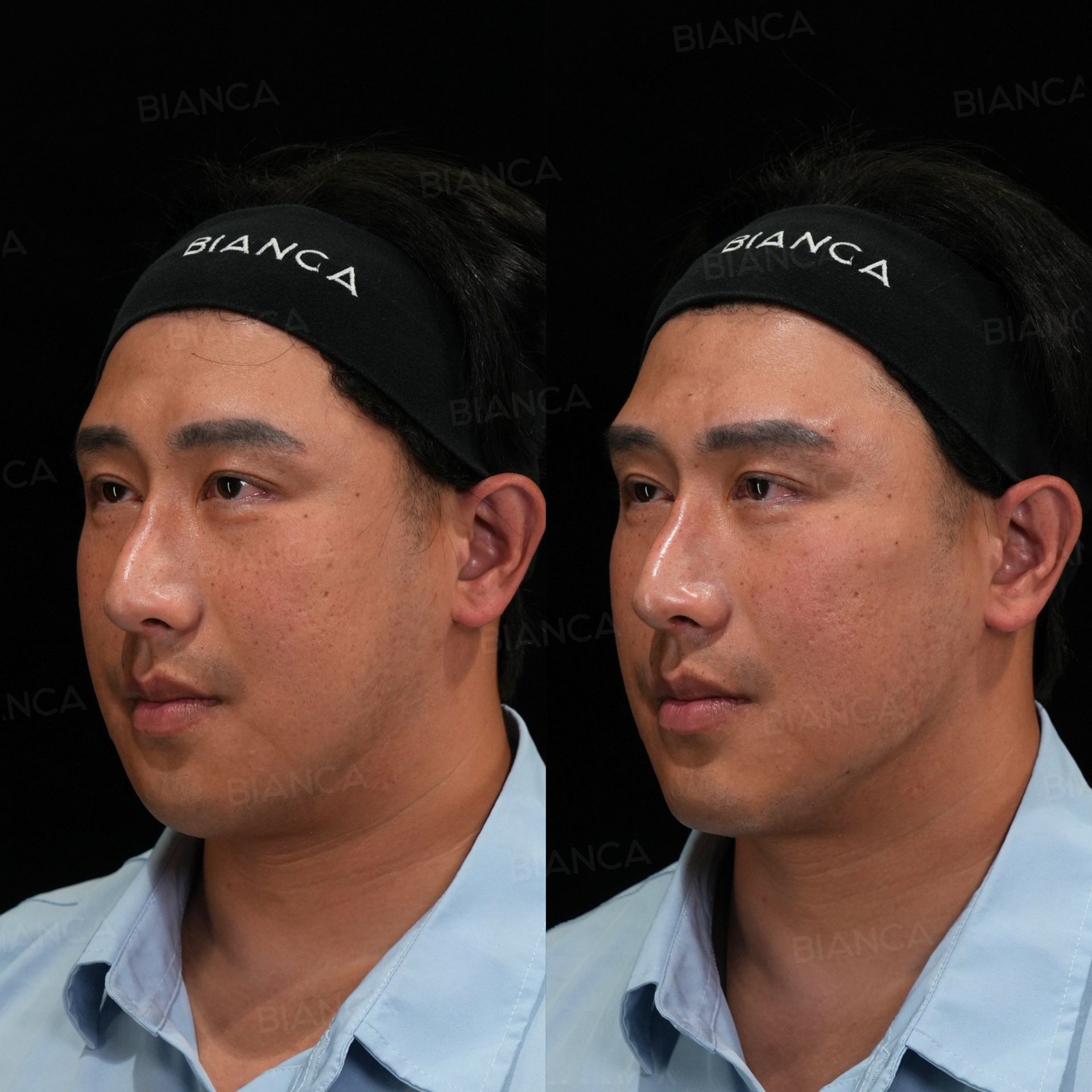 Hyaluronic acid filler before and after NEAUVIA STIMULATE in the midcheek groove, cheeks and chin, left three-quarter view, immediately after treatment