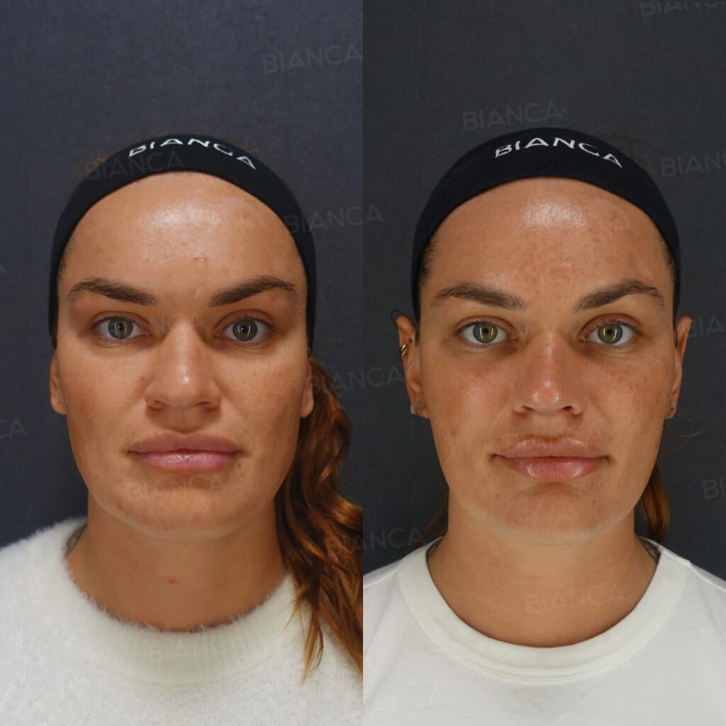 Hyaluronic Acid Injection (Midcheek Groove, Lips: Restylane Lyft, Juvederm VOLBELLA), Thread Lift (BIANCA LIFT)