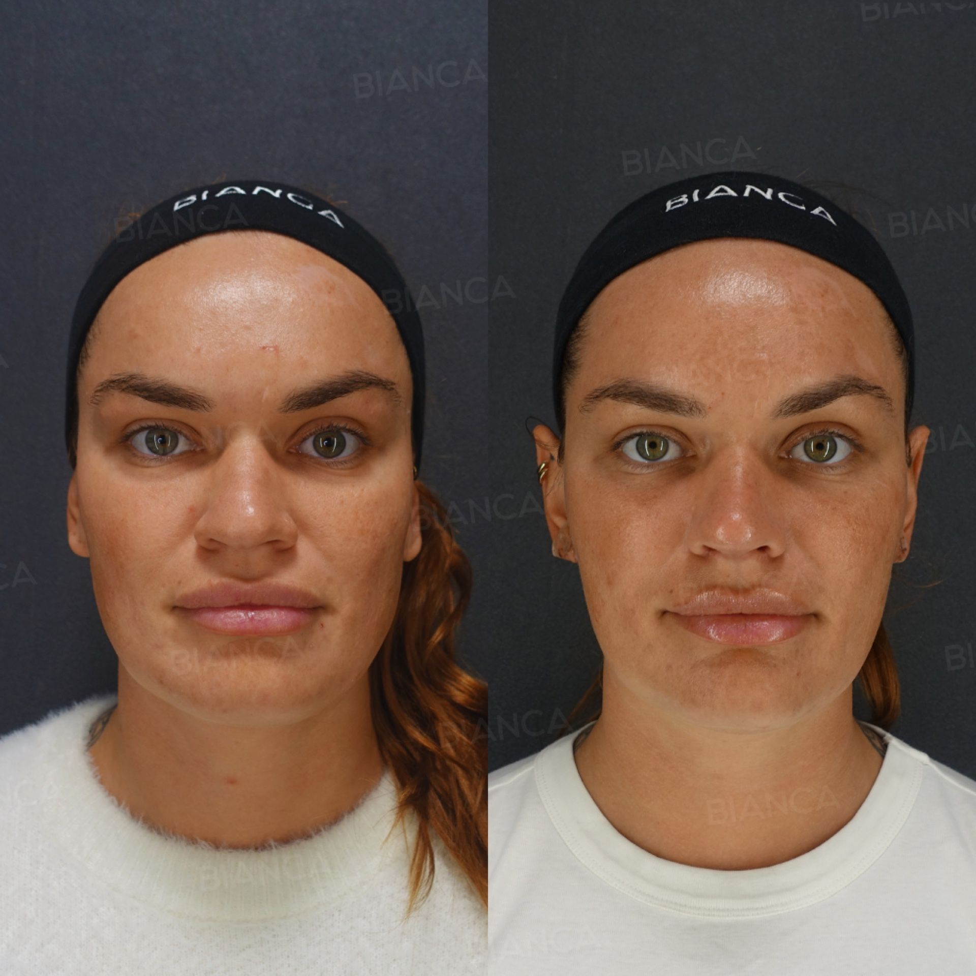 Hyaluronic Acid Injection (Midcheek Groove, Lips: Restylane Lyft, Juvederm VOLBELLA), Thread Lift (BIANCA LIFT)