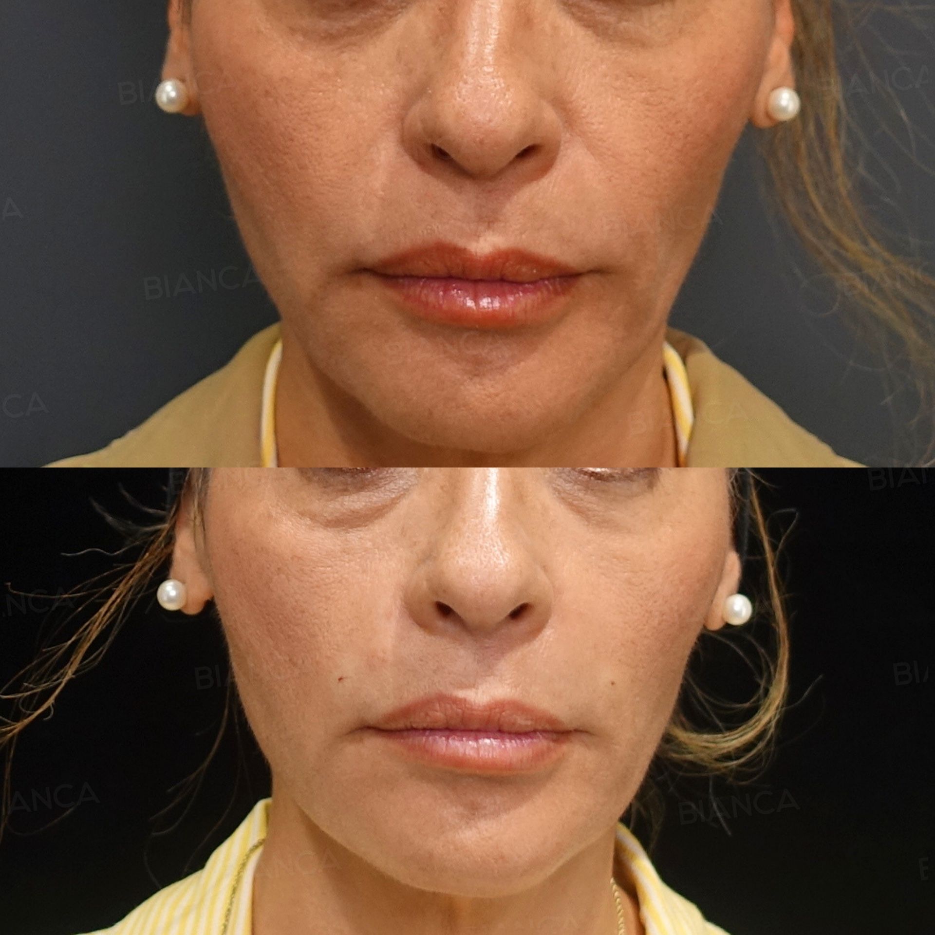 Hyaluronic acid filler before and after correction of the nasolabial folds with Juvederm VOLUMA XC, front view, immediately after treatment