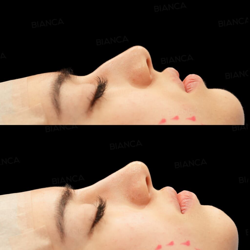 Hyaluronic Acid Injection (Nose)