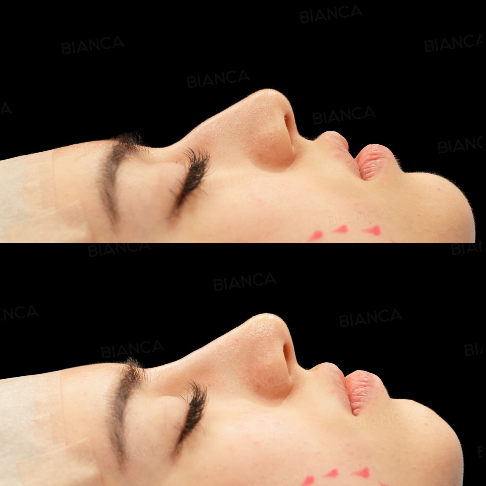 Hyaluronic Acid Injection (Nose)