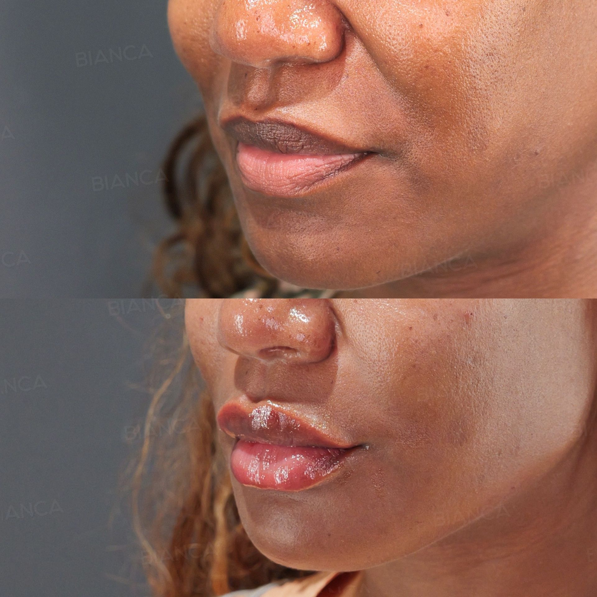Hyaluronic acid filler before and after NEAUVIA injection to the cheeks and chin, three-quarter view of the lower face, immediately after treatment