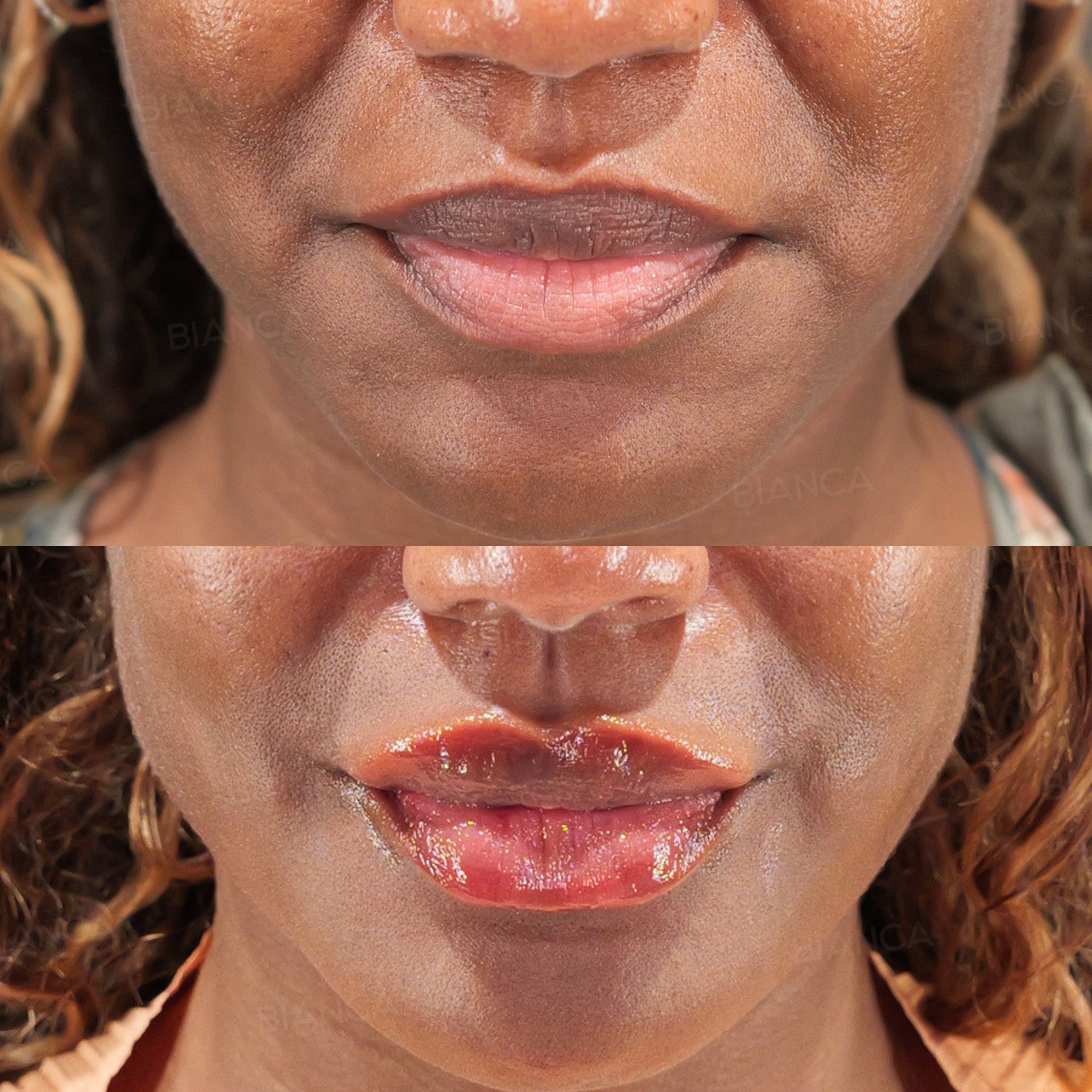 Hyaluronic acid filler before and after NEAUVIA injection to the lower face, front view of the mouth and chin, immediately after treatment