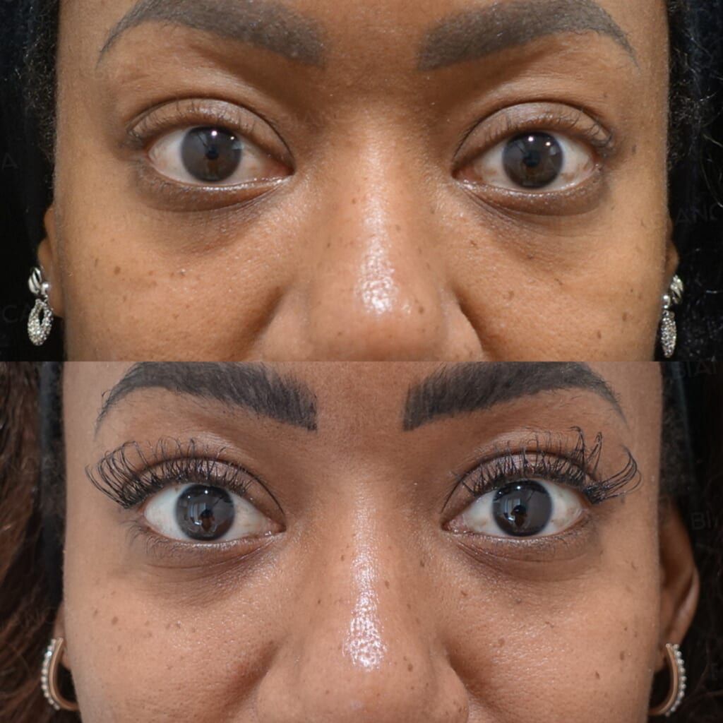 Hyaluronic Acid Injection (Nose, Midcheek Groove, Cheeks, Chin: NEAUVIA INTENSE, NEAUVIA LV, NEAUVIA RHEOLOGY, NEAUVIA FLUX)