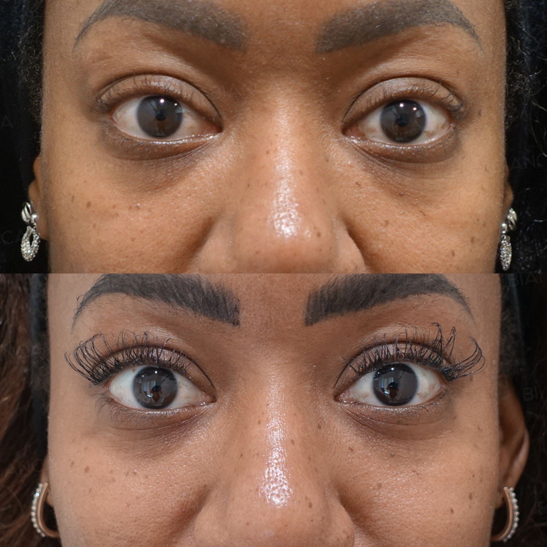 Hyaluronic Acid Injection (Nose, Midcheek Groove, Cheeks, Chin: NEAUVIA INTENSE, NEAUVIA LV, NEAUVIA RHEOLOGY, NEAUVIA FLUX)