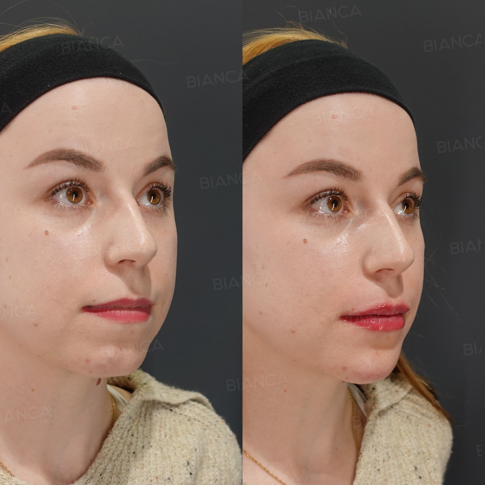 Hyaluronic Acid Injection (Nose, Nasolabial Folds, Alar Base, Chin)