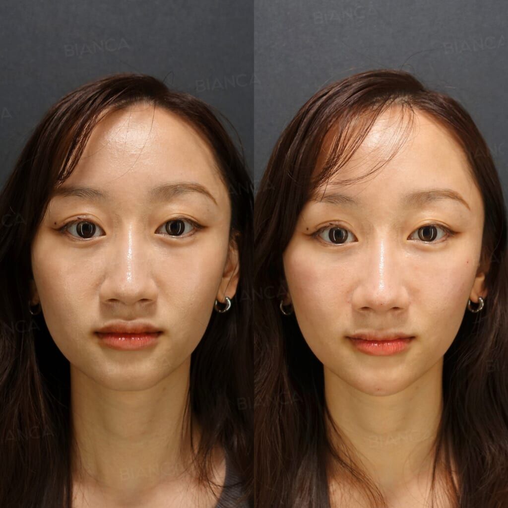 Hyaluronic Acid Injection (Nose Tip, Alar Base, Chin: Restylane Lyft)