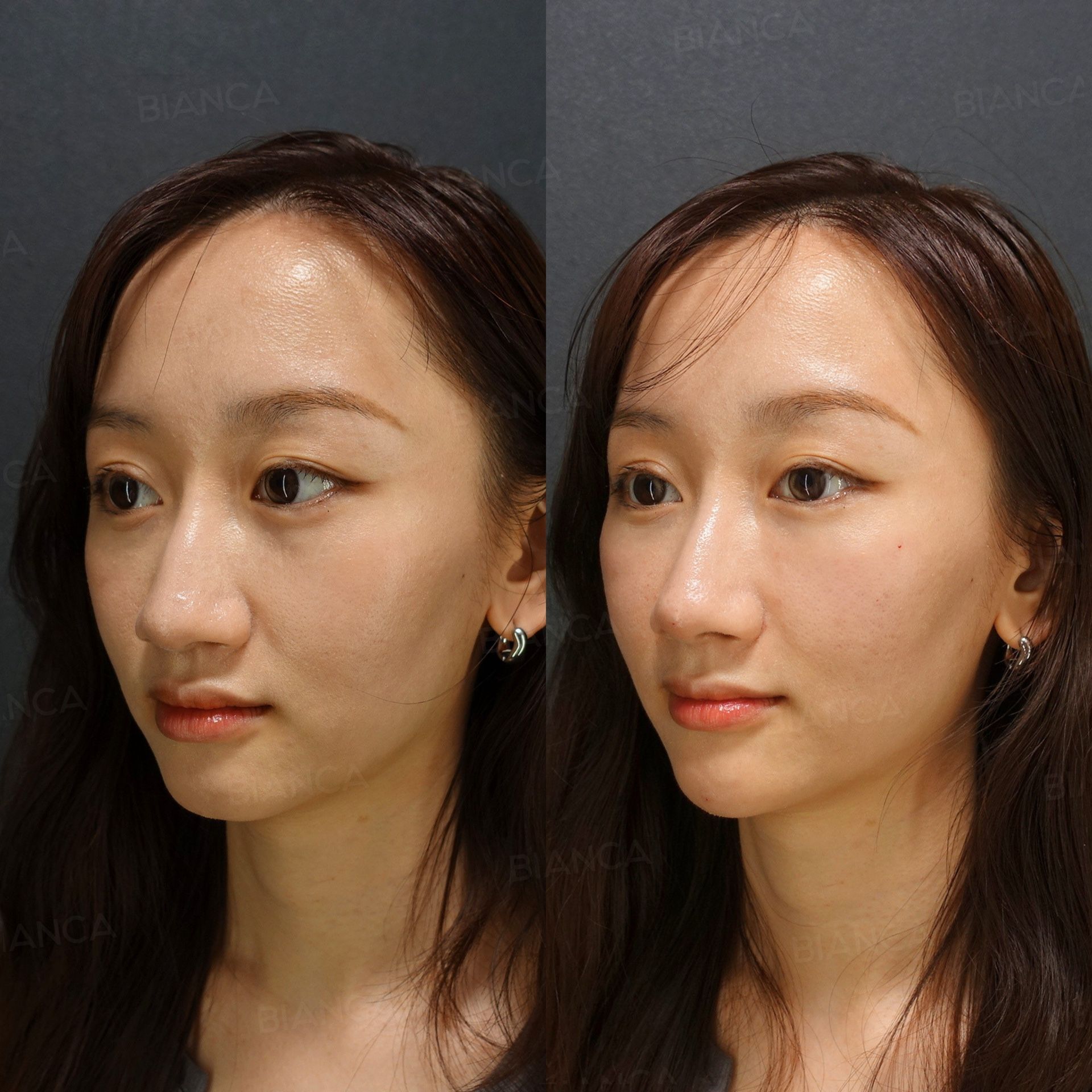 Hyaluronic acid filler before and after Restylane Lyft placed in the nose tip, alar base and chin, three-quarter view immediately after treatment