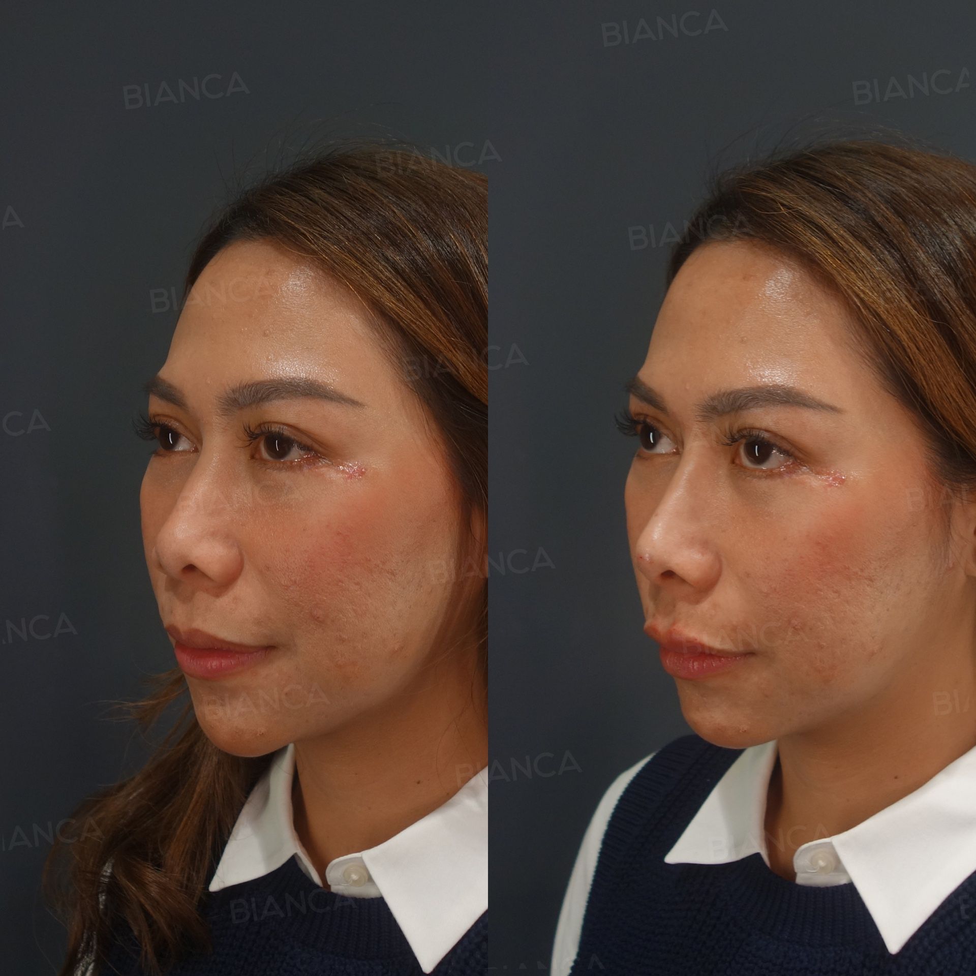 Hyaluronic acid filler before and after treatment of the nose tip with NEAUVIA INTENSE and the lips with Juvederm VOLBELLA, three-quarter view at 1 month