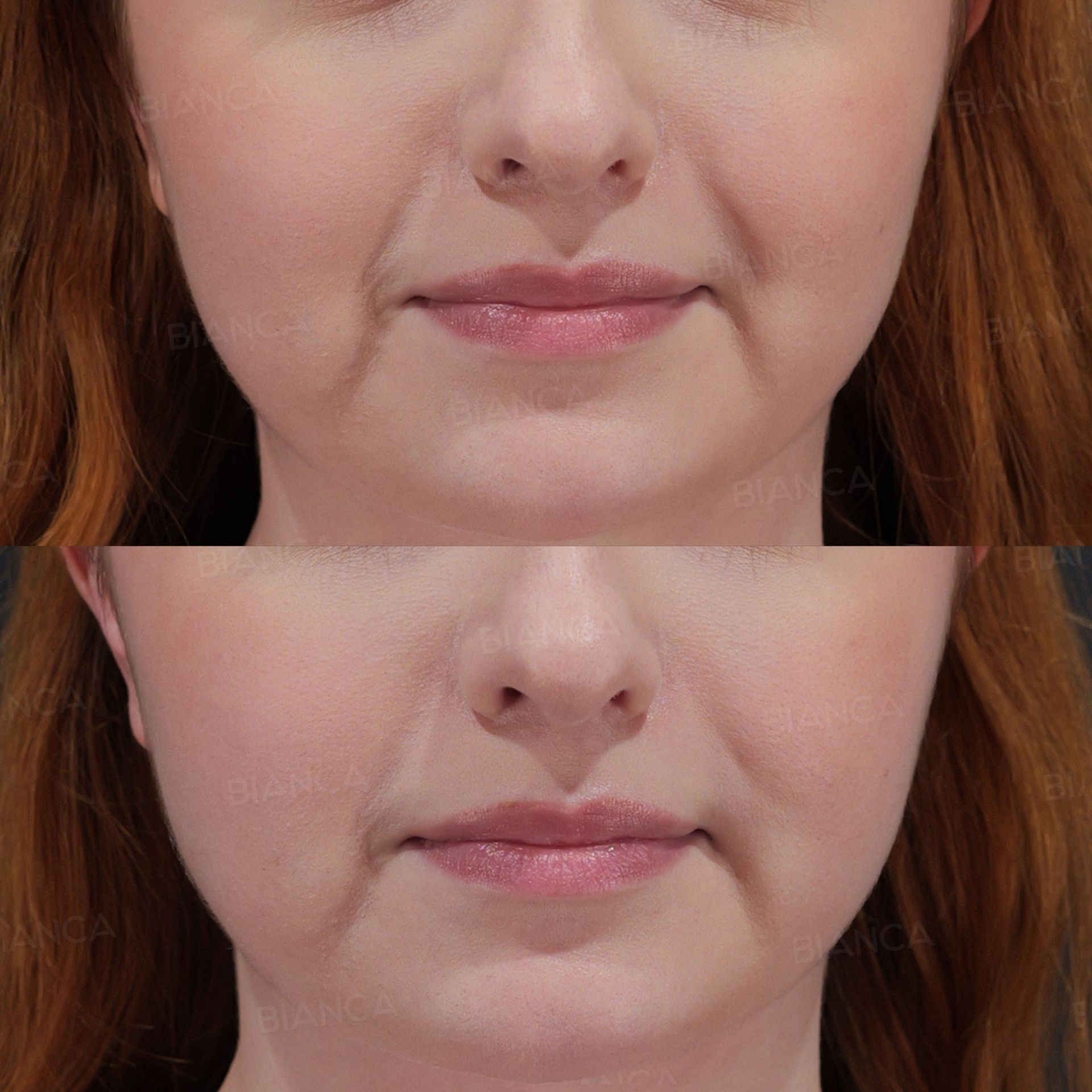 Hyaluronic acid filler before and after NEAUVIA treatment of the nasolabial folds, chin and jawline in the lower face, front view, immediately after treatment