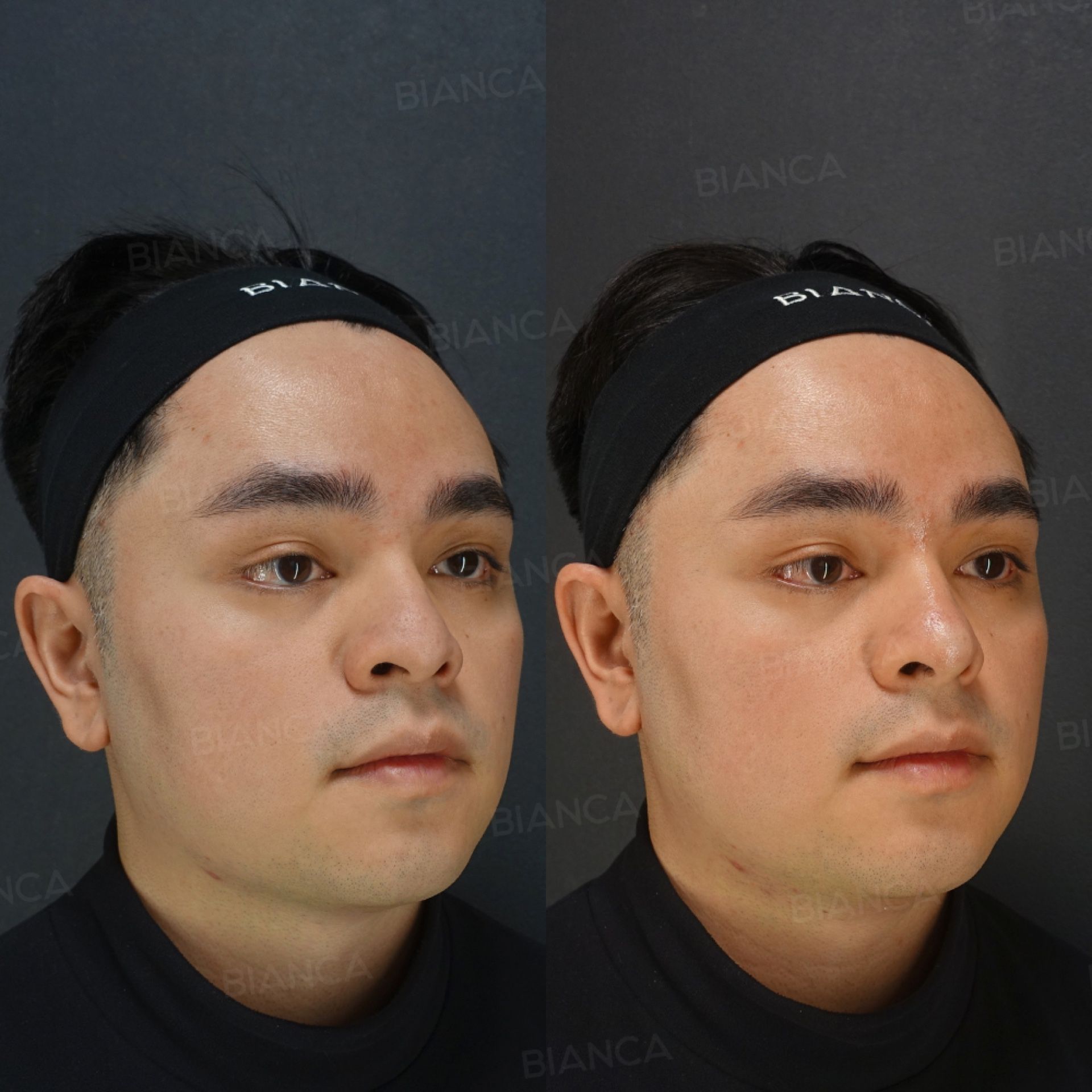 Hyaluronic acid filler before and after nose tip augmentation with NEAUVIA INTENSE, three-quarter view, immediately after treatment
