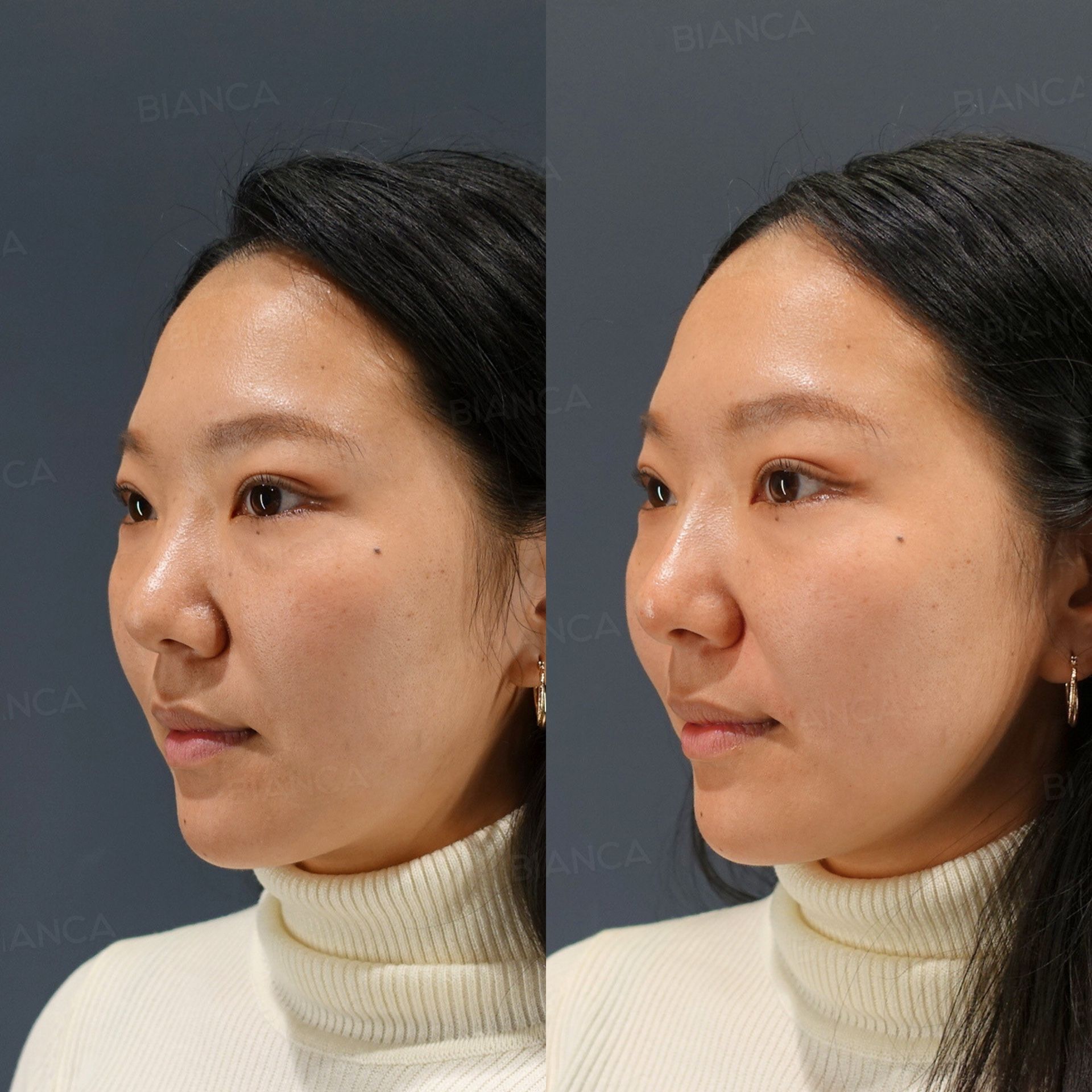 Hyaluronic acid filler before and after Restylane Lyft placed in the nose tip only, with the bridge left untreated, three-quarter view, immediately after treatment