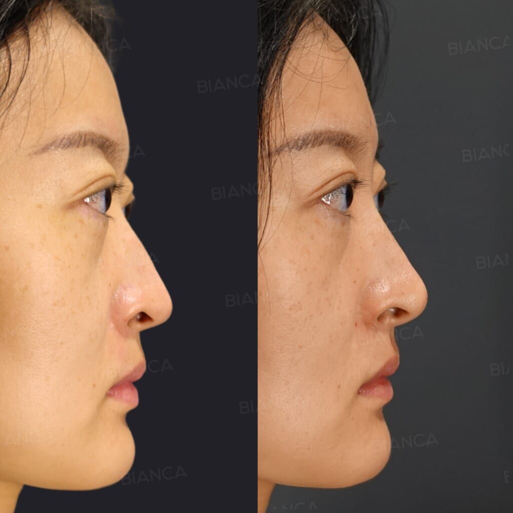 Hyaluronic Acid Injection (Nose Tip: Restylane Lyft)