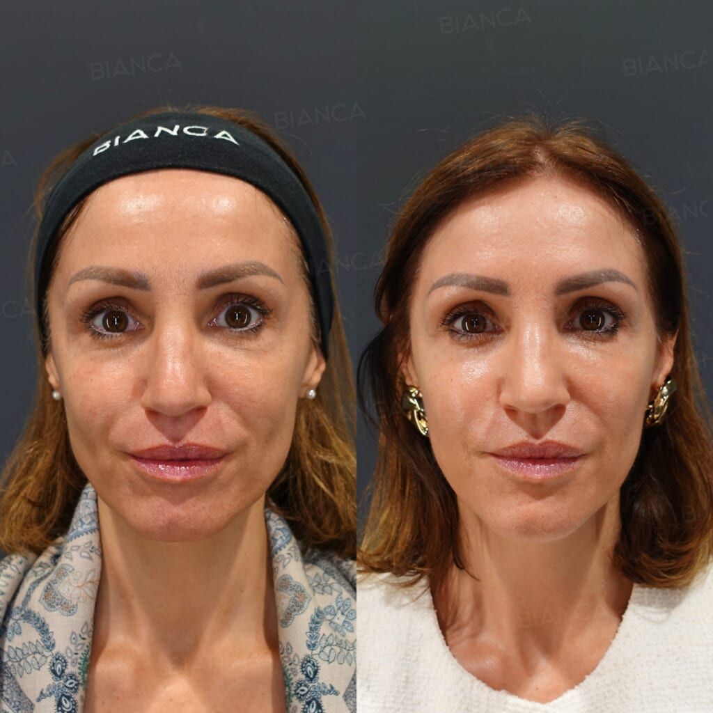 Hyaluronic Acid Injection (Temples, Hollow Cheeks, Nasolabial Folds, Cheeks, Marionette Lines: Restylane Lyft, Juvederm VOLIFT, Juvederm VOLBELLA), Baby Collagen (Under Eyes)