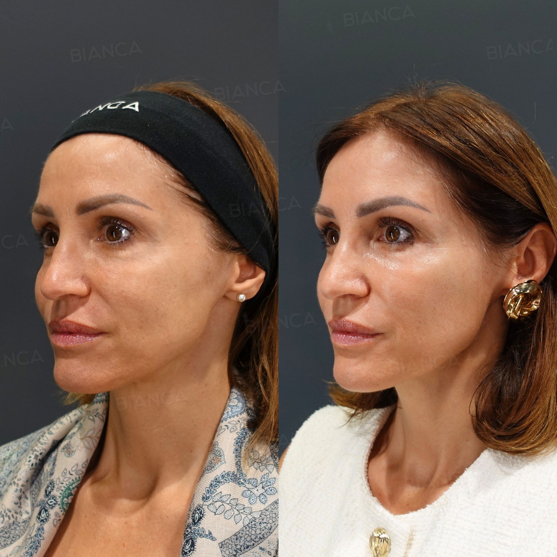 Hyaluronic Acid Injection (Temples, Hollow Cheeks, Nasolabial Folds, Cheeks, Marionette Lines: Restylane Lyft, Juvederm VOLIFT, Juvederm VOLBELLA), Baby Collagen (Under Eyes)
