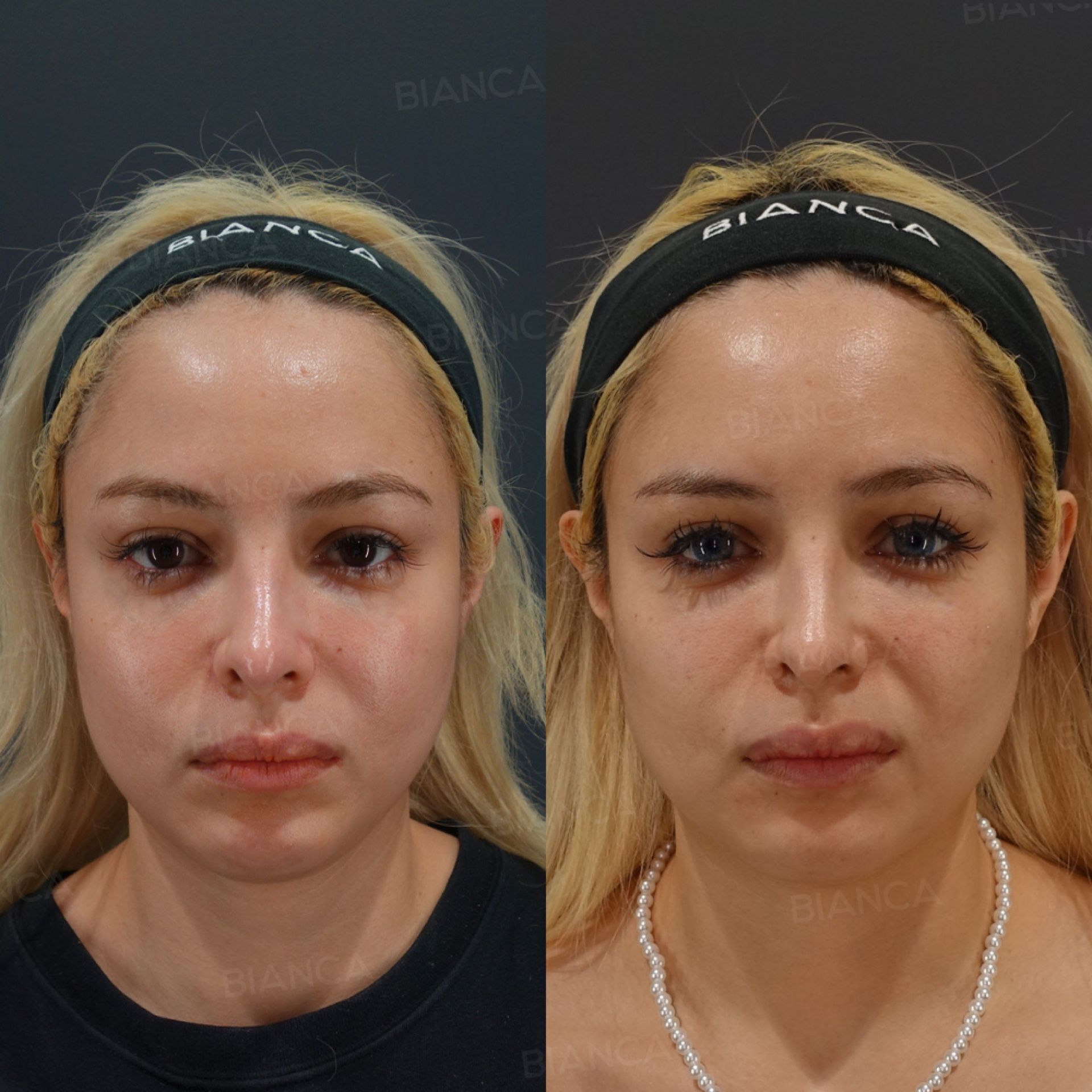 Hyaluronic acid filler before and after Juvederm at the temples, midcheek groove and lips with Coretox botulinum toxin, front view at just after and 2 weeks