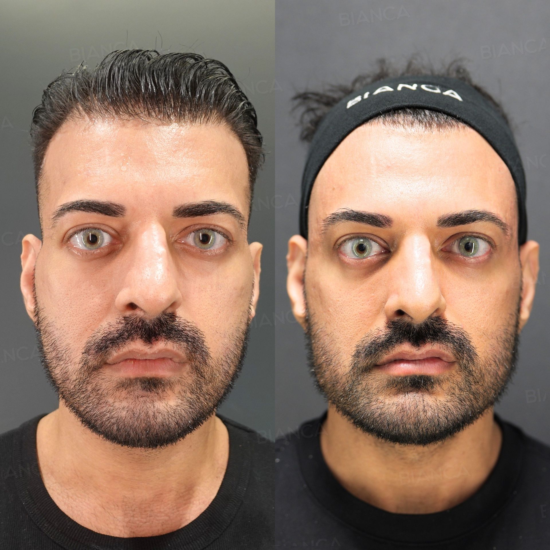 Hyaluronic acid filler before and after NEAUVIA STIMULATE placed deep in the hollow temples, head and shoulders in front view, immediately after treatment