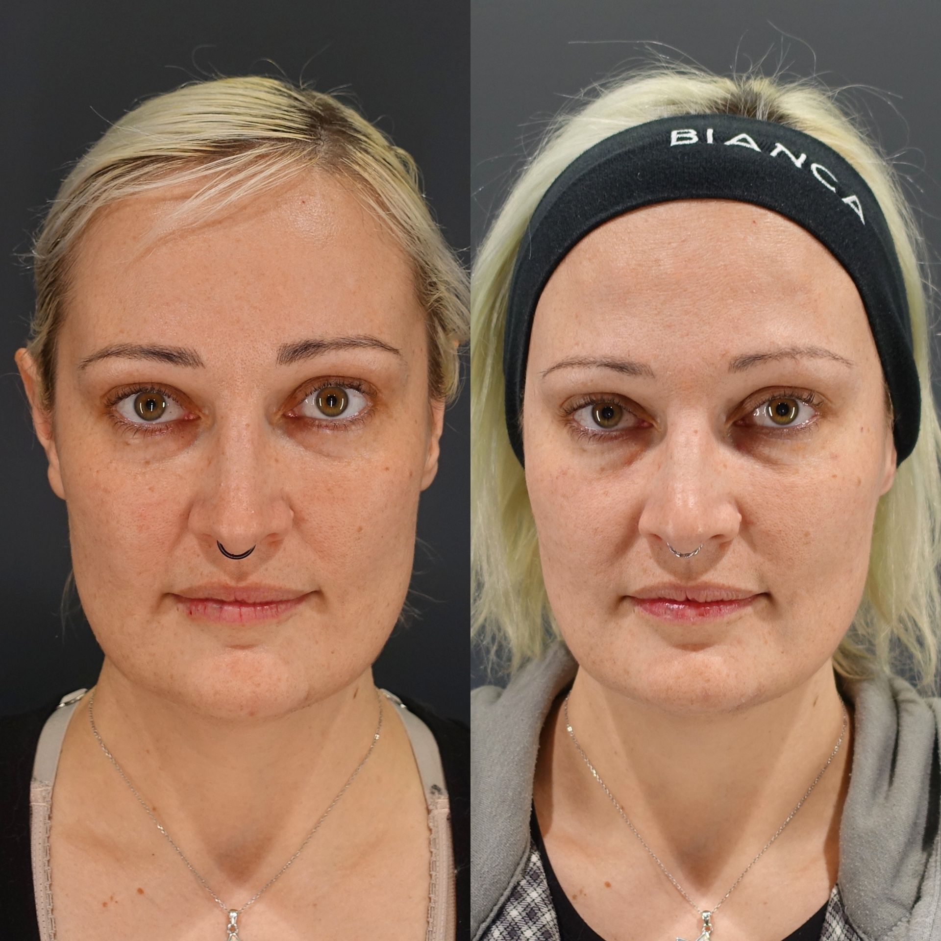 Hyaluronic acid filler before and after deep injection into the hollow under the eyes, front view at 1 month