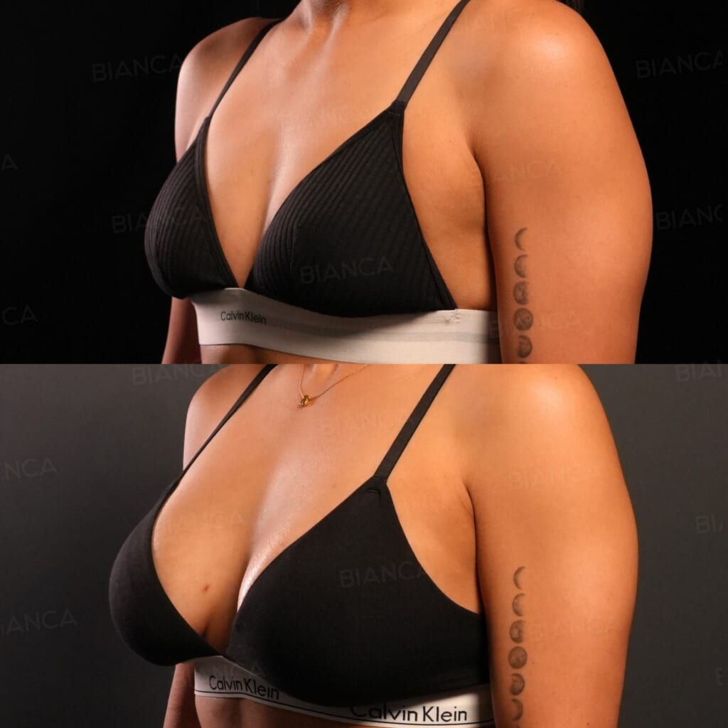 Hybrid Breast Augmentation (Preserve FULL Implant 320 cc, Fat Grafting 207 cc Right, 220 cc Left)