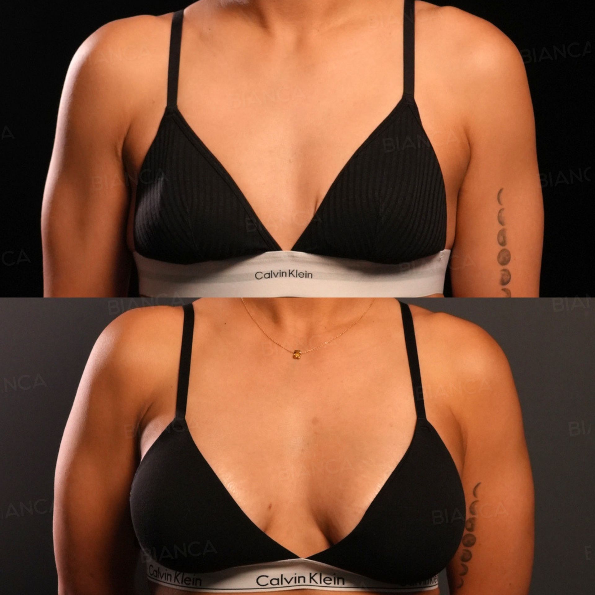 Hybrid breast augmentation before and after a 320 cc Preserve FULL implant with fat grafting, 207 cc on the right and 220 cc on the left, front view, at 1 month