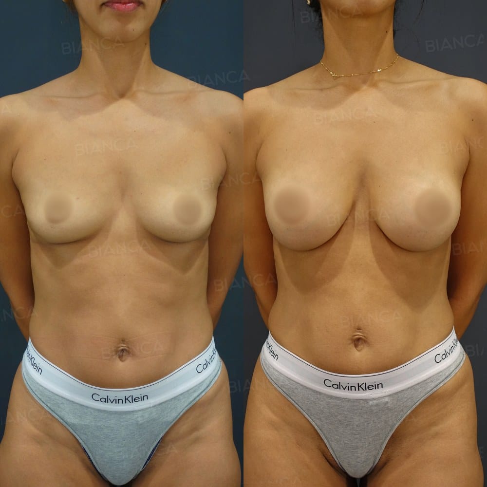 Hybrid Breast Augmentation (Silicone Implant + Condense Rich Fat) before and after, 6 months, BIANCA CLINIC Tokyo