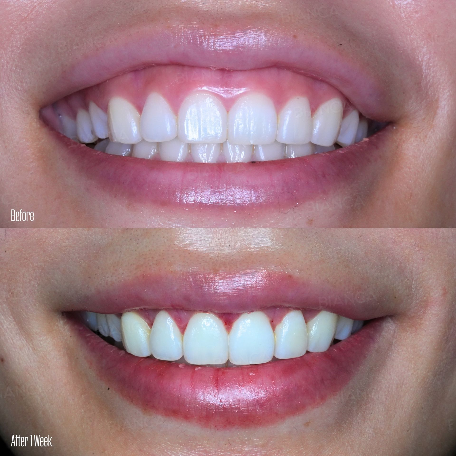 Lip lift before and after upper lip repositioning by mucosal resection, front view photographed at full smile at 1 week