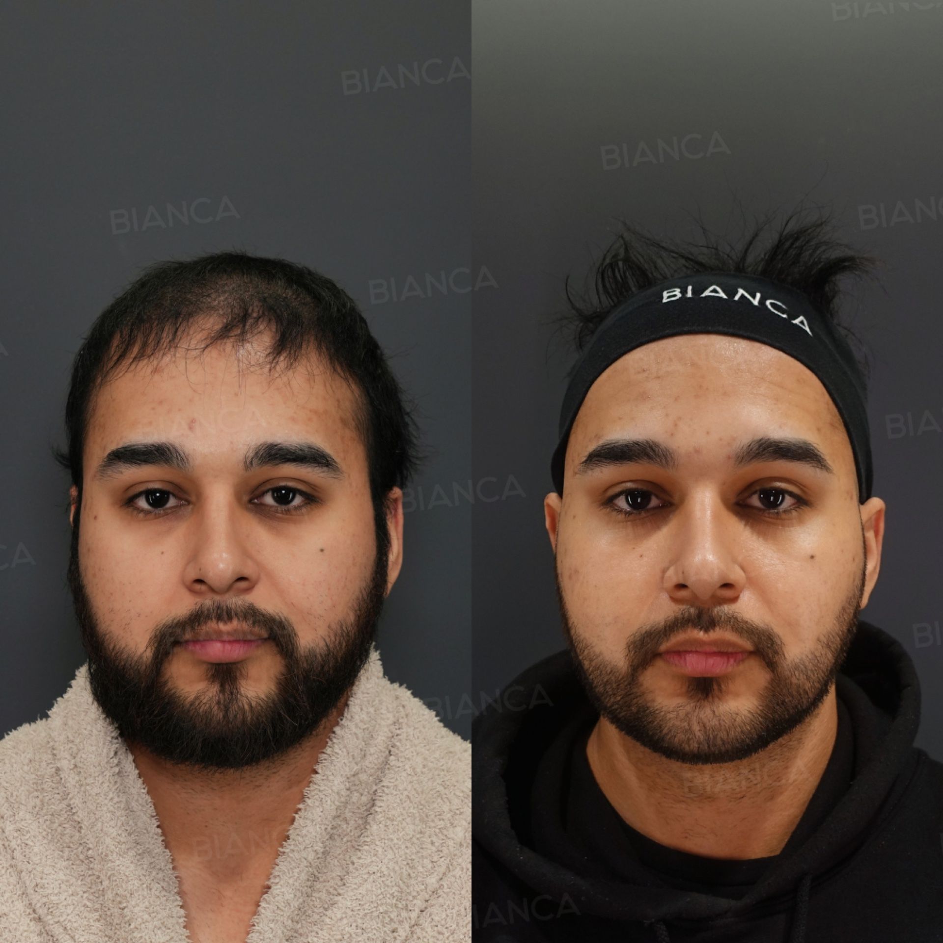 Facial liposuction (VASER) before and after cheek and submental contouring with buccal fat removal and a BIANCA LIFT thread lift, front view, at 3 months