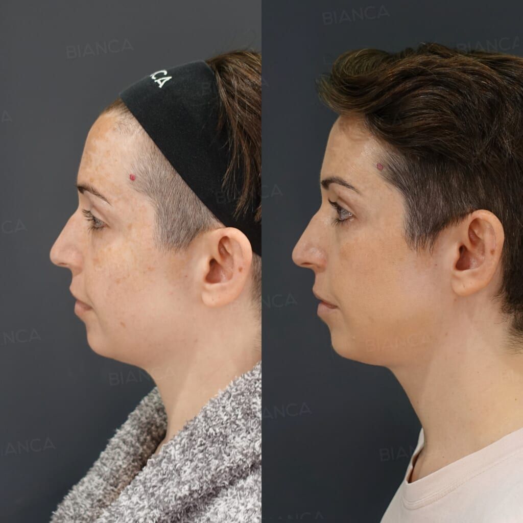 Liposuction (Submental), FaceTite (Submental), Morpheus8 (Submental)
