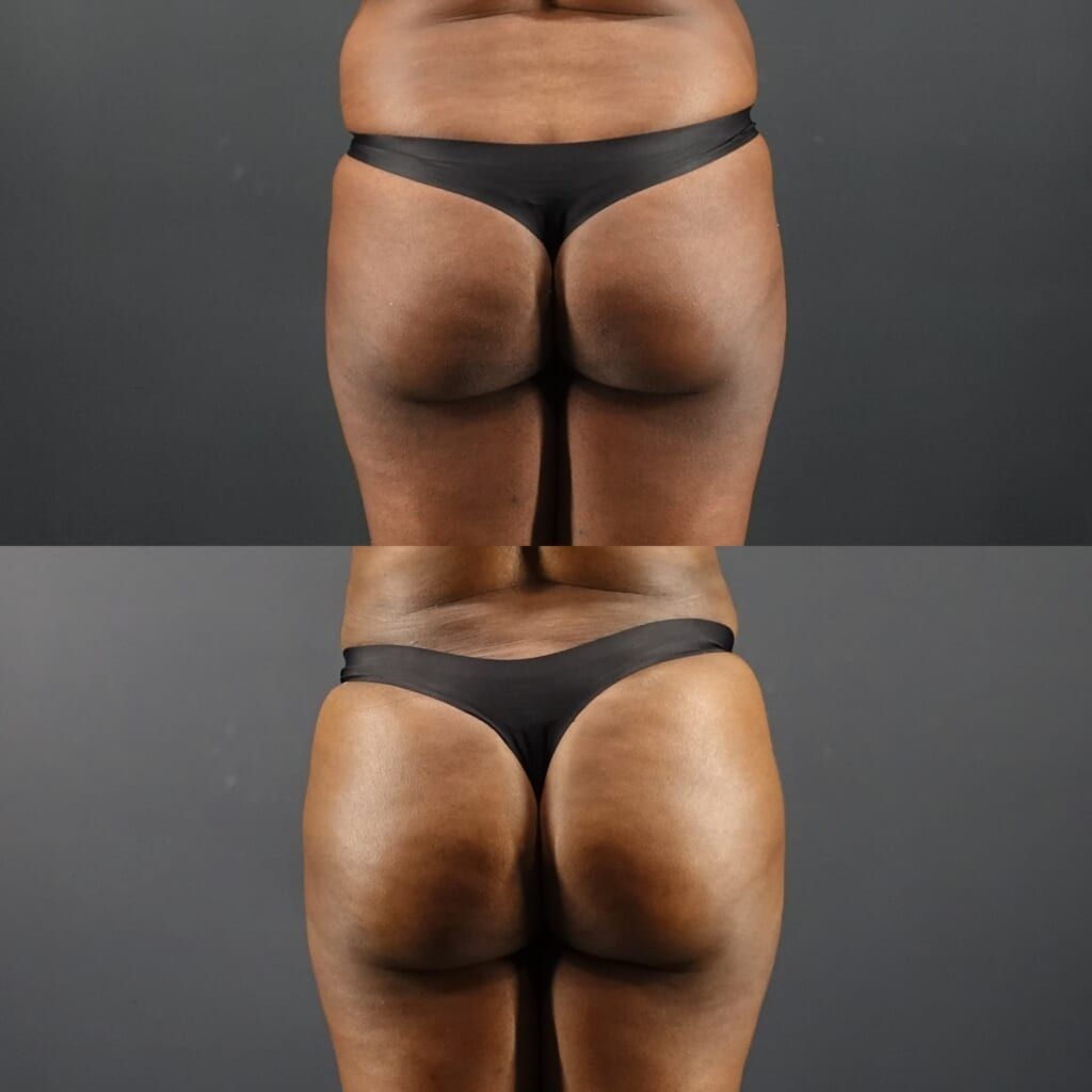 Liposuction (Upper & Lower Abdomen, Flanks, Upper & Lower Back, Waist), Brazilian Butt Lift (BBL)