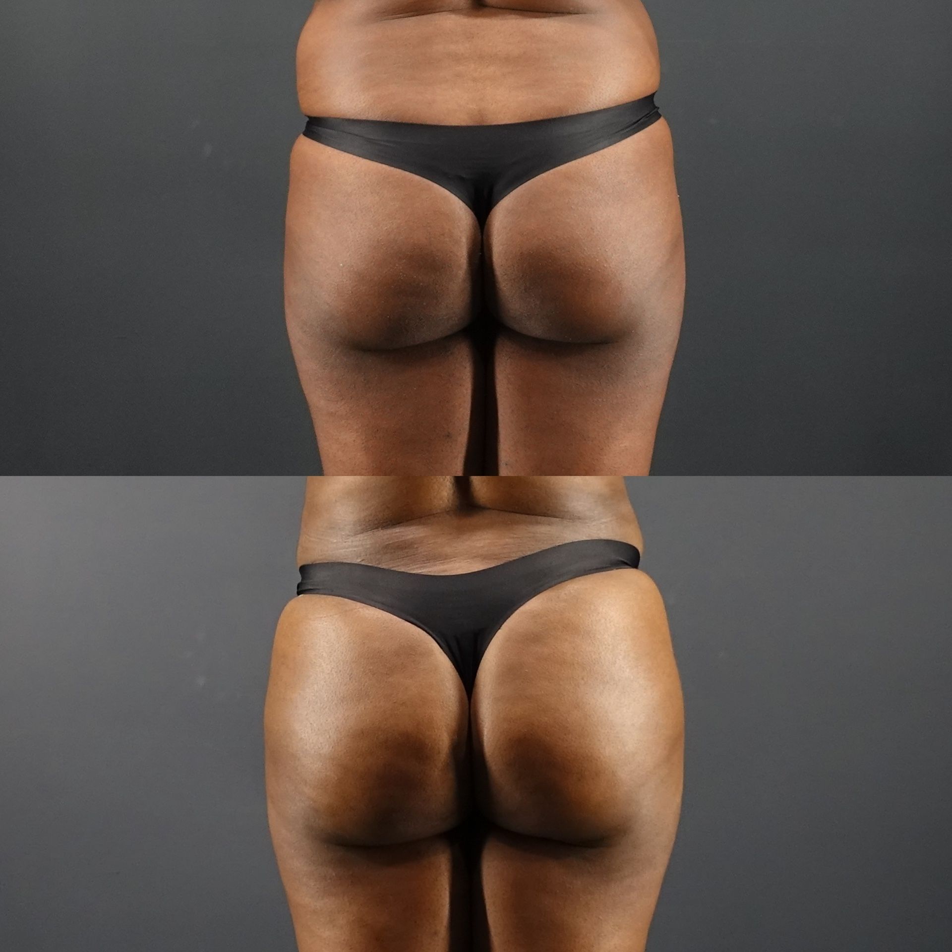 Liposuction (Upper & Lower Abdomen, Flanks, Upper & Lower Back, Waist), Brazilian Butt Lift (BBL)