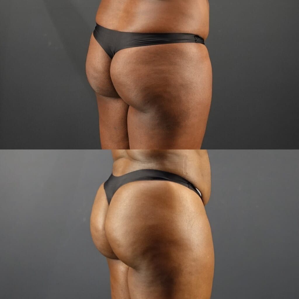 Liposuction (Upper & Lower Abdomen, Flanks, Upper & Lower Back, Waist), Brazilian Butt Lift (BBL)