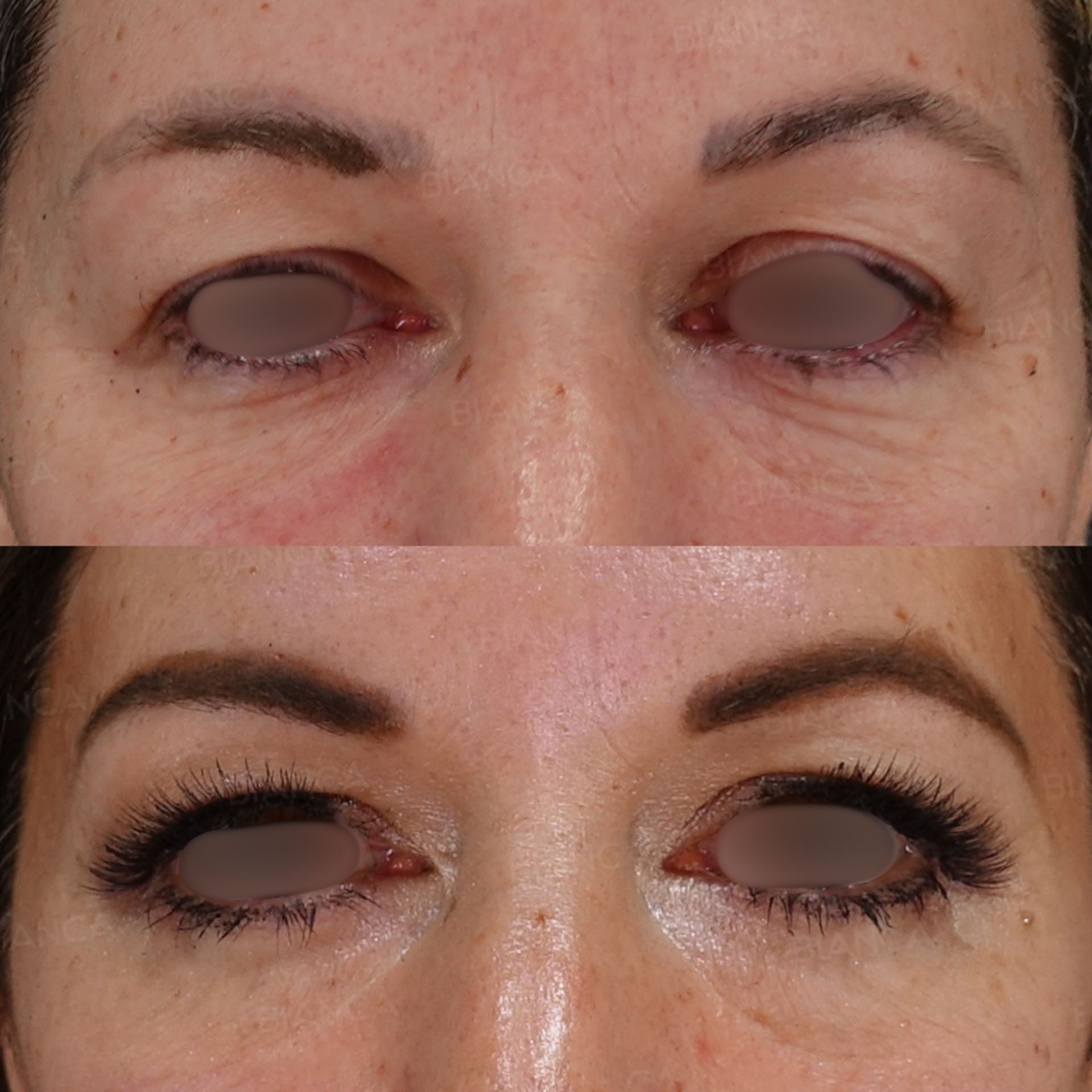 Lower Eyelid Skin Excision (Lower Blepharoplasty)