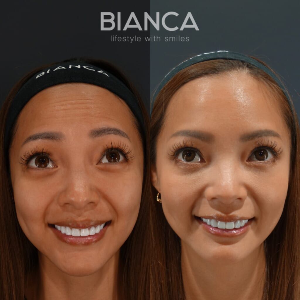 Massage Peel (Face), Botox Injection (Forehead, Glabella, Chin, Periorbital Area, Inner Eye Corners: Allergan)