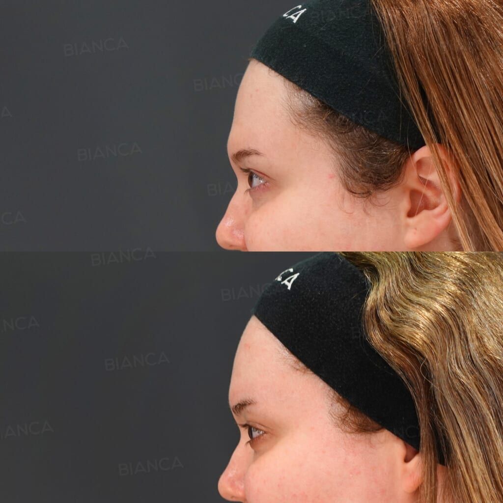 Massage Peel (Face), Mesona J (Face, Neck), Botox Injection (Forehead, Glabella: Allergan), Hyaluronic Acid Injection (Forehead: Juvederm VOLUMA XC)