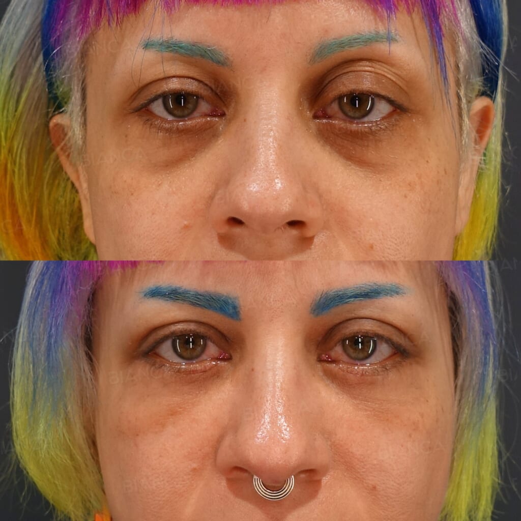 Mid-face Lift (Subperiosteal) + Upper Eyelid Sagging Removal before and after, 1 month, BIANCA CLINIC Tokyo
