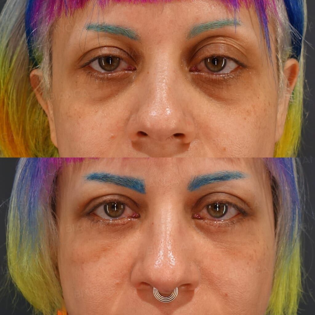 Midface Lift (Subperiosteal) + Upper Eyelid Skin Excision (Upper Blepharoplasty)