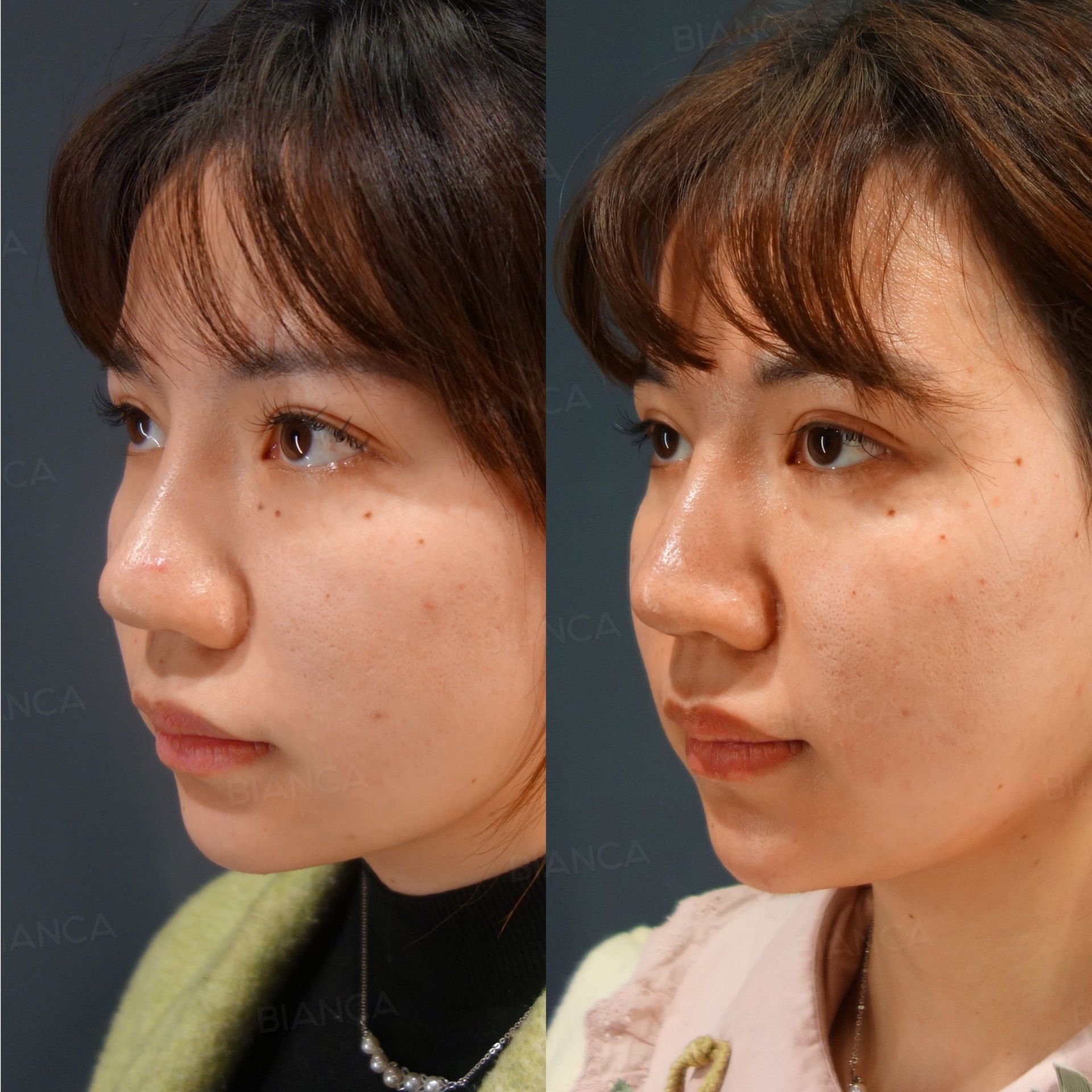 Mole and Wart Removal