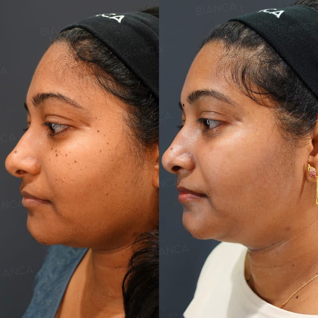 Mole and Wart Removal