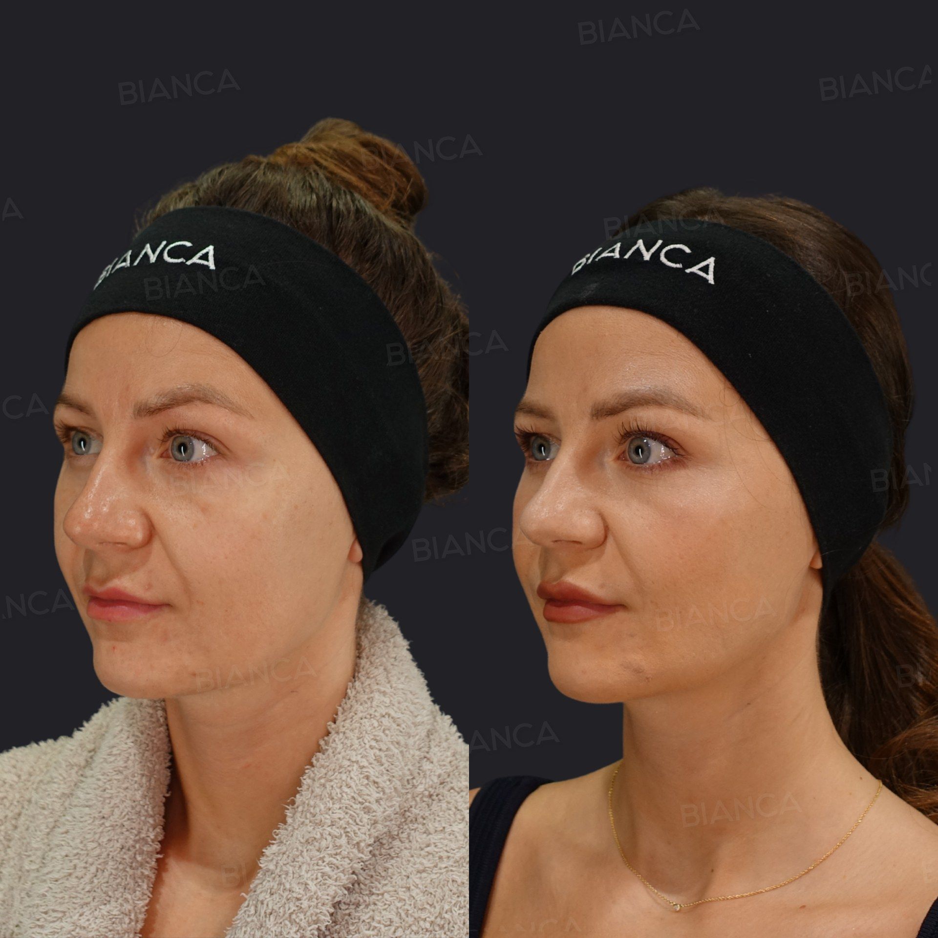 Morpheus8 (Submandibular) + EmbraceRF (Face and Submandibular) before and after, 1 month, BIANCA CLINIC Tokyo