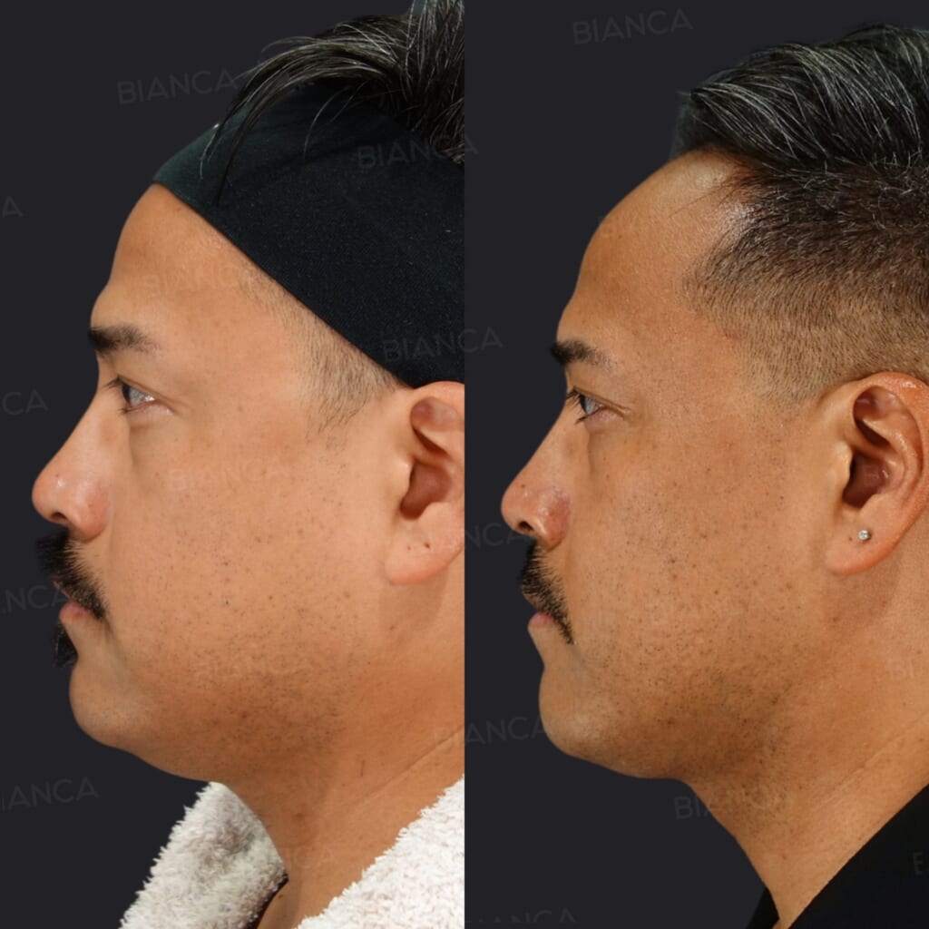 Morpheus8 + EmbraceRF (Face) + Submental Liposuction before and after, after treatment, BIANCA CLINIC Tokyo