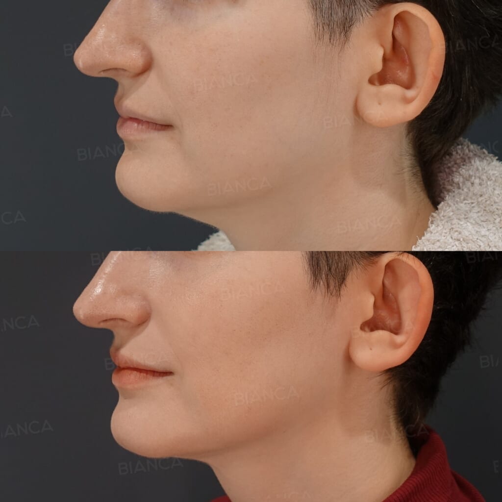 Morpheus8 (Submandibular) + EmbraceRF (Face) + Submental Liposuction before and after, 3 months, BIANCA CLINIC Tokyo