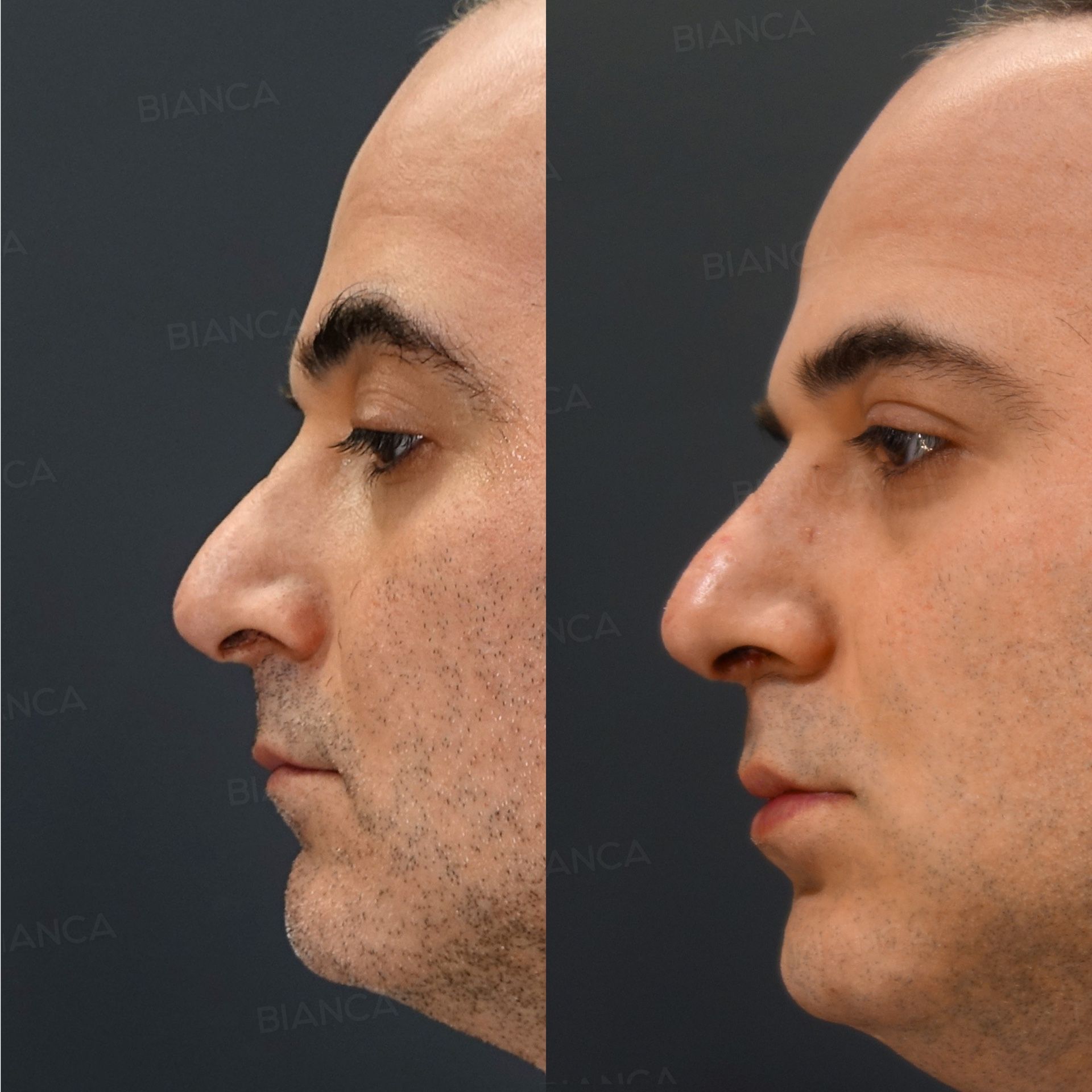 Reduction rhinoplasty before and after columellar scar revision combined with nasal bone osteotomy and bridge narrowing, side view of the nose at 2 months