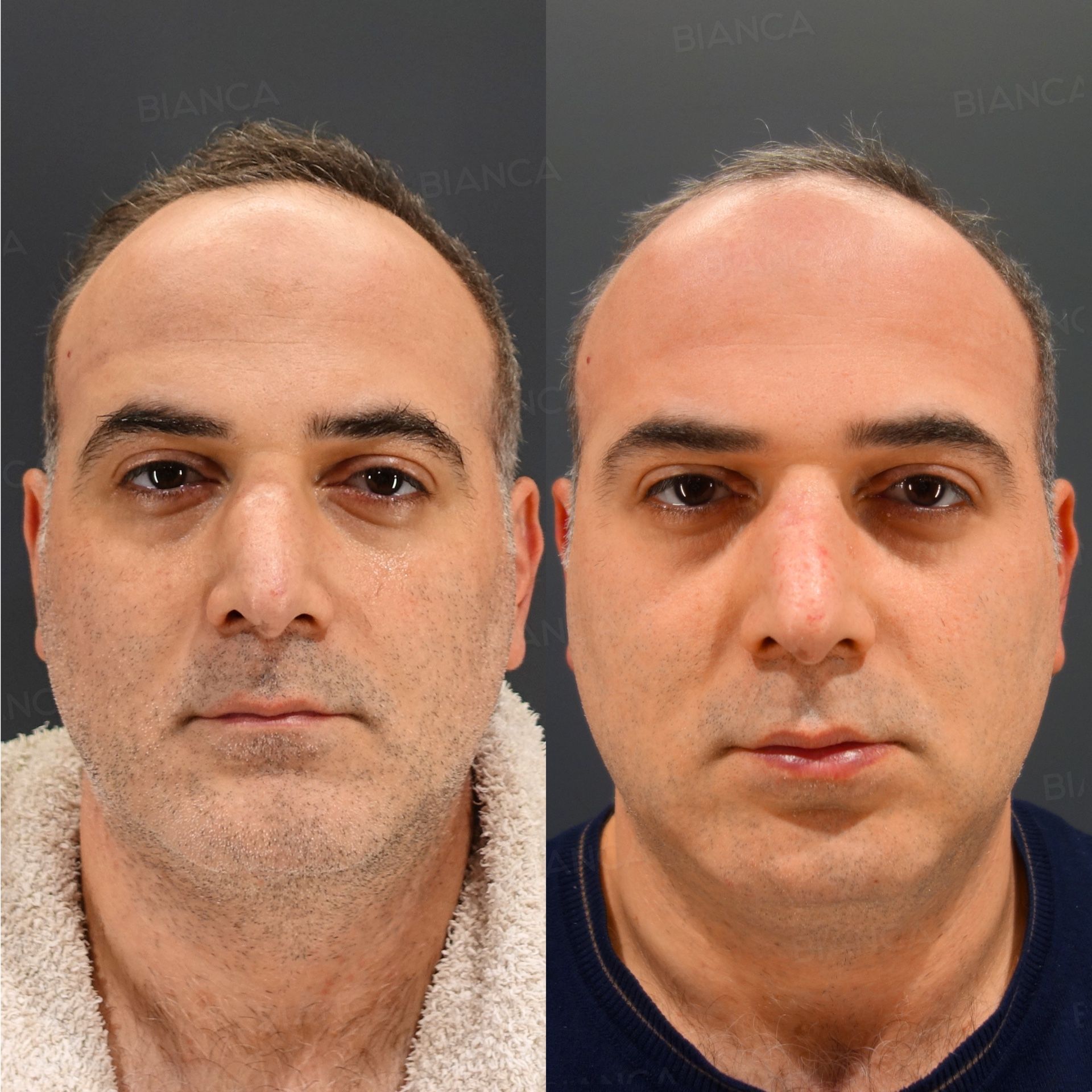 Reduction rhinoplasty before and after nasal bone osteotomy with narrowing and columellar scar revision, front view of the face at 2 months