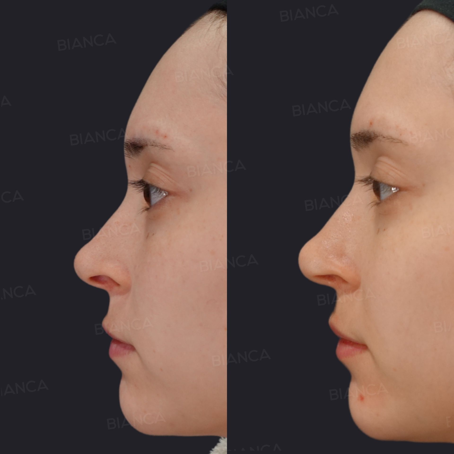 Reduction rhinoplasty before and after nasal bone osteotomy, tip plasty and alar rim lowering with auricular cartilage graft, side view of the nose at 6 months