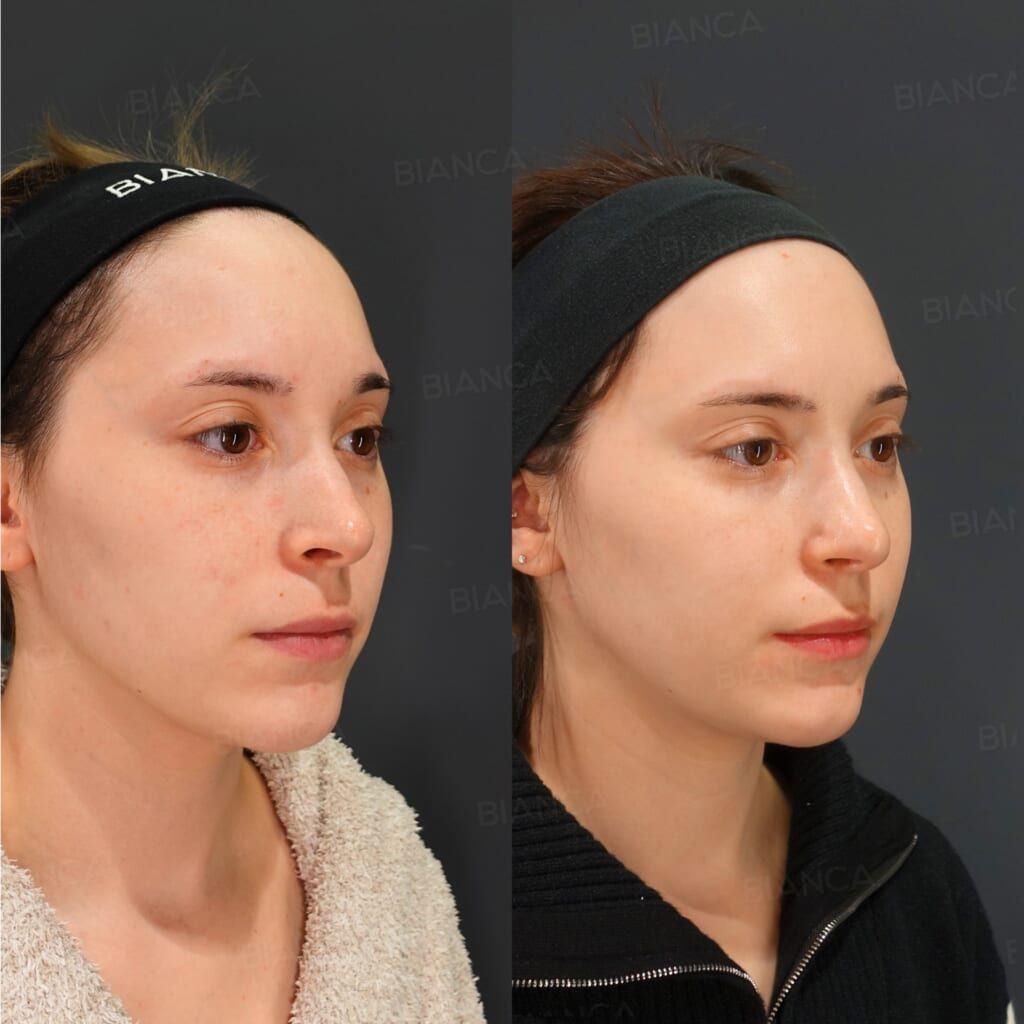 Nasal Bone Osteotomy with Narrowing, Tip Plasty, Alar Rim Lowering (Skin Graft, Auricular Cartilage Graft)