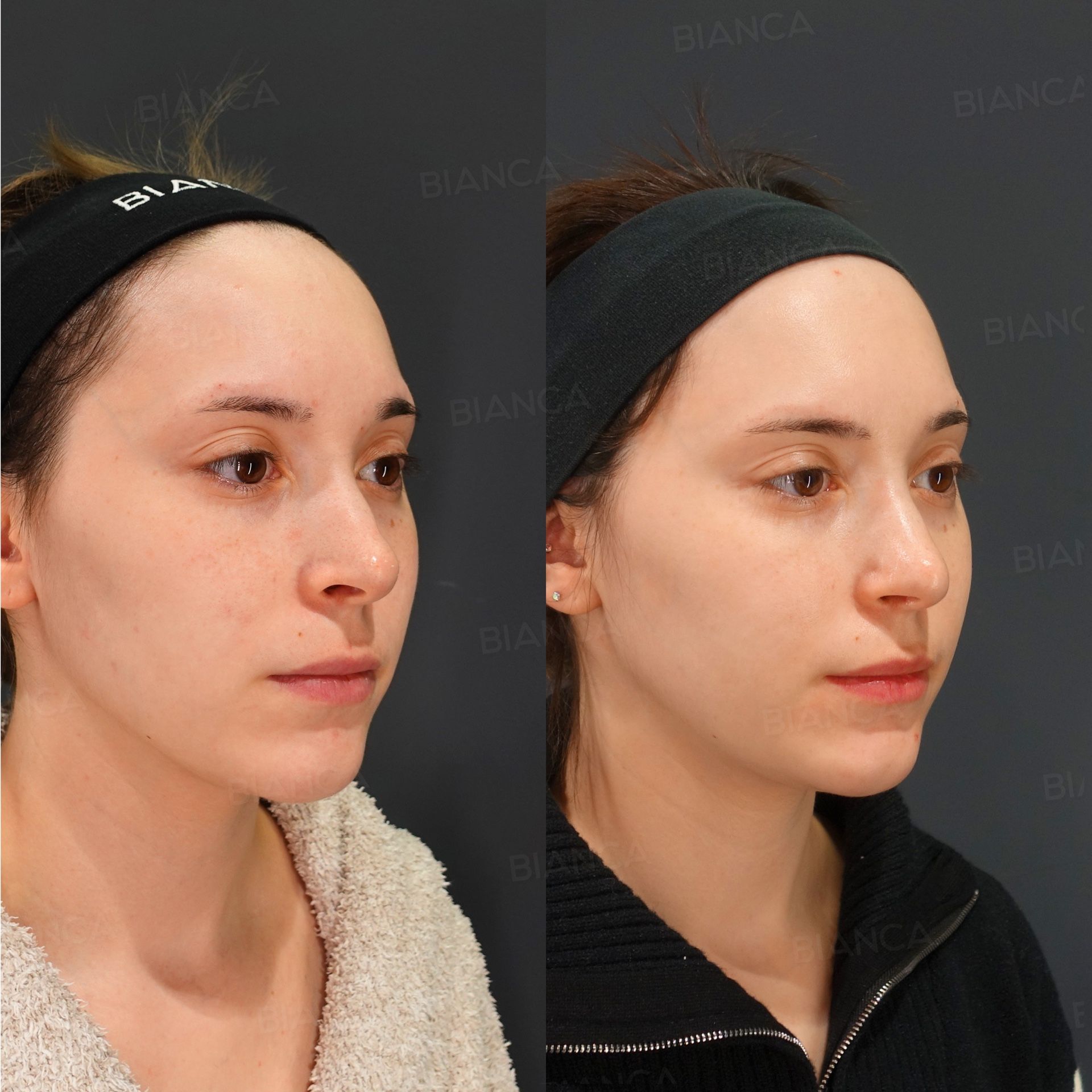 Nasal Bone Osteotomy with Narrowing, Tip Plasty, Alar Rim Lowering (Skin Graft, Auricular Cartilage Graft)