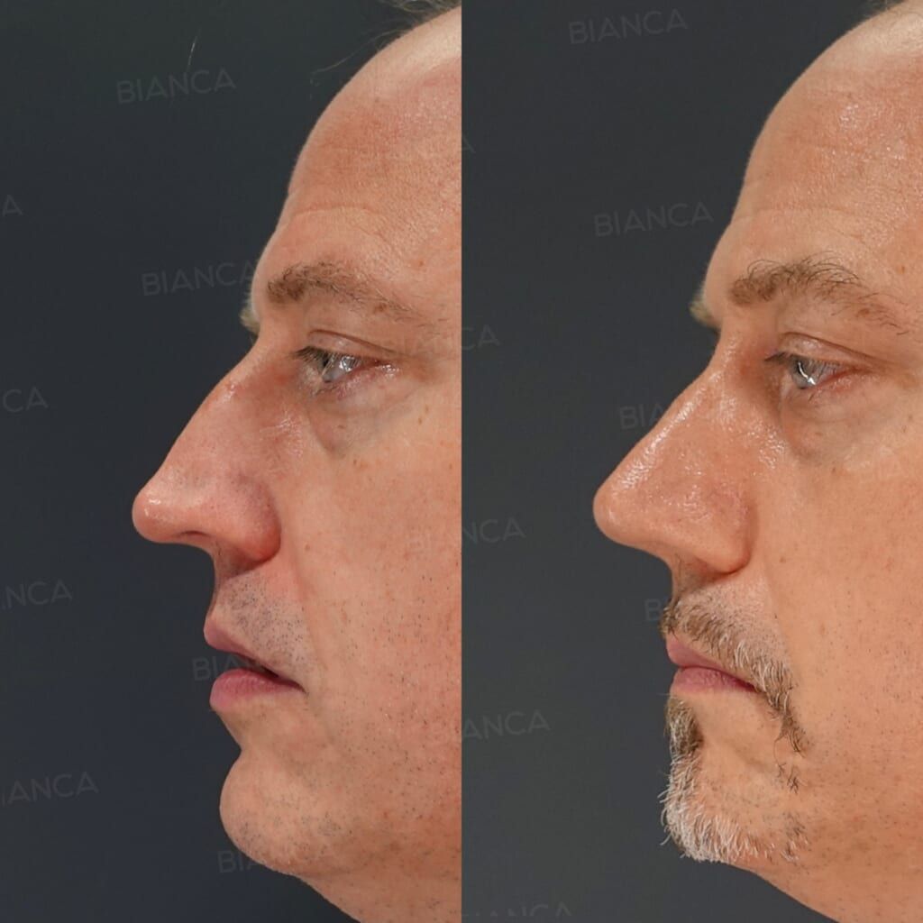 Nasal Tip Reduction, Dorsal Hump Reduction (Aquiline Nose Correction)