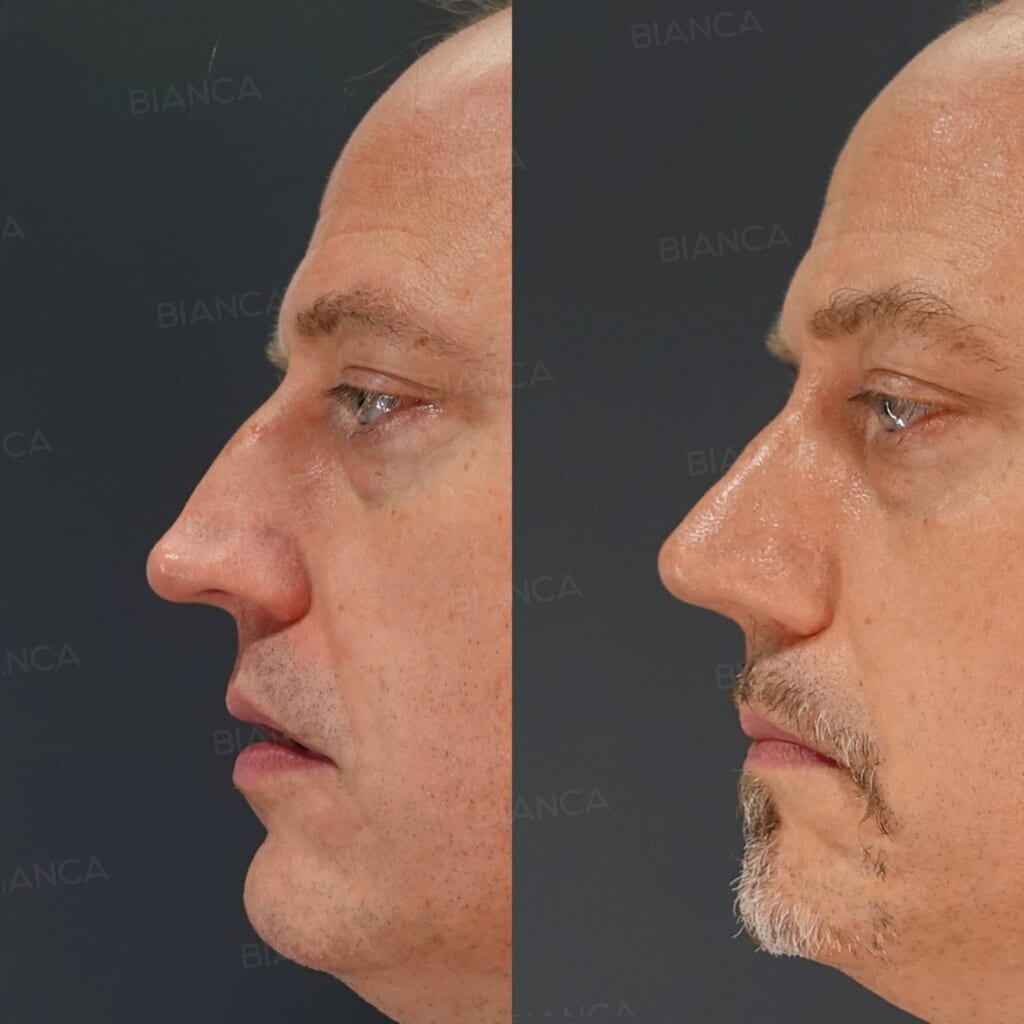 Nasal Tip Reduction + Hump Reduction (Dorsal Hump Removal) before and after, 3 months, BIANCA CLINIC Tokyo