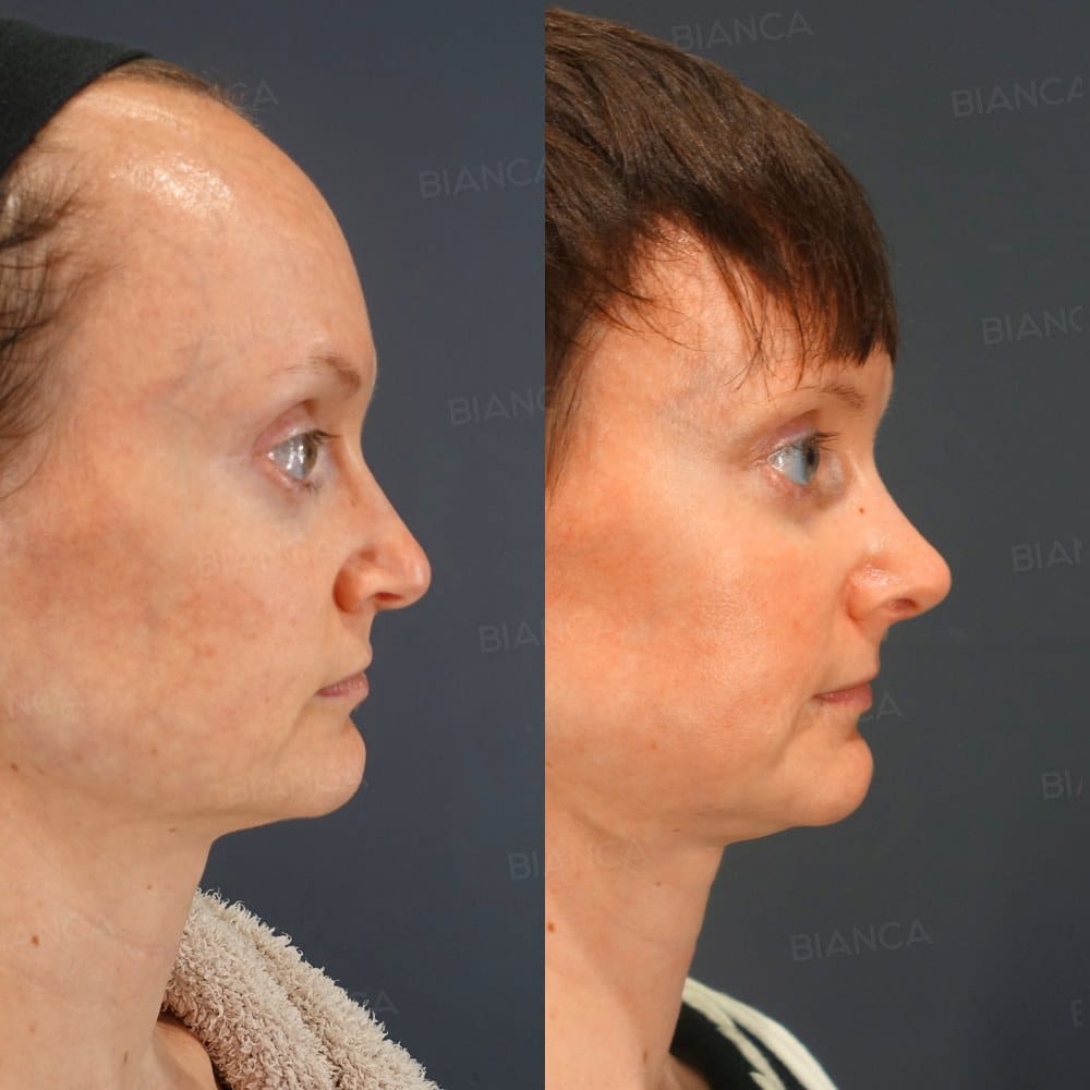 Nasal Tip Shaping + Nasal Tip Cartilage Graft + Columella Strut before and after, 6 months, BIANCA CLINIC Tokyo